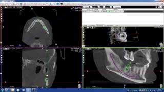 Implant PLanning with Acteon Imaging Suite CBCT Cone Beam [upl. by Septima]