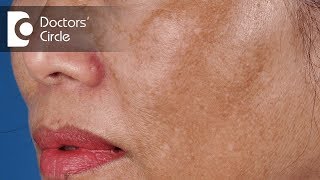 Treatment of Melasma  Dark Spots on Face  Dark patch on face  Dr Satish D A  Doctors Circle [upl. by Castera513]