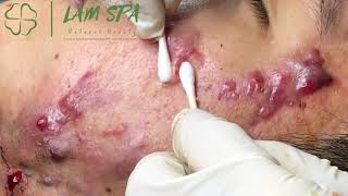 Treatment of acne pustules severe inflammation  Điều trị mụn mủ viêm nặng  LAMSPA PHUQUOC L P11 [upl. by Floeter]