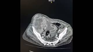 Pyonephrosis of transplanted kidney while atrophic fibrosed and calcified native kidneys [upl. by Emmet]