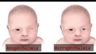 what is Anophthalmia  Microphthalmia  Terms means  Optometry solution [upl. by Saree83]