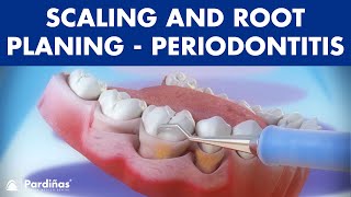 Treatment of periodontal disease  Scaling and root planing  Tartar © [upl. by Attenal]