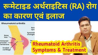 Rheumatoid Arthritis Cause Symptoms Diagnosis and Treatment  in Hindi [upl. by Winton]