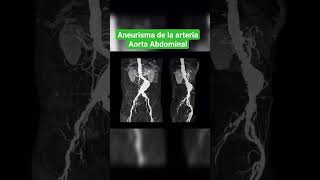 ANEURISMA DE LA ARTERIA AORTA ABDOMINAL ANGIOGRAFÍA [upl. by Aliled]