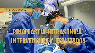 ¿Cómo es la Recuperación de una Rinoplastía 🤔⚕️ [upl. by Gavrah97]