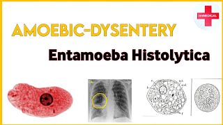 AmebiasisAmoebic dysentery Entamoeba histolytica pathogenesissign amp symptoms treatment [upl. by Ailsa]