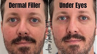 How to get rid of under eye hollows darkness Under eye restoration with dermal fillers [upl. by Nooj]