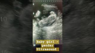 Baby girl gender reveal ultrasound ultrasound shortfeed baby pregnant ytviral shortsviral yt [upl. by Kora]