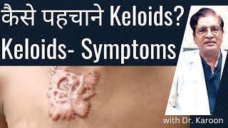 Keloids Symptoms and Signs in Hindi  कैसे पहचाने Keloid Scar  Dr Karoon Agrawal [upl. by Eeresid]