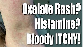 Oxalate Dumping Skin Rash Histamine Connections Between Oxalate Histamine Mold amp Pyroluria [upl. by Ayotahc]