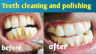 teeth cleaning and polishing [upl. by Jamnis]