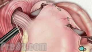 AntiReflux Laparoscopy Surgery PreOp® Patient Education Medical video [upl. by Ellehcem990]