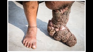 Filariasis or elephantiasis causes symptoms and treatment [upl. by Pammie]