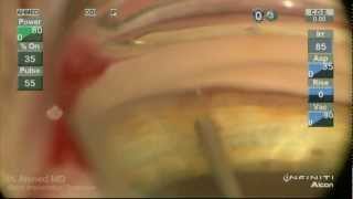 iStent Trabecular MicroBypass Implantation Ike Ahmed [upl. by Lauryn]