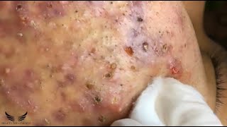 Blackhead Whitehead Removal  Cystic Acne Treatment  Elderly Pimple Popping  Facial Acne Spa 082 [upl. by Becca]