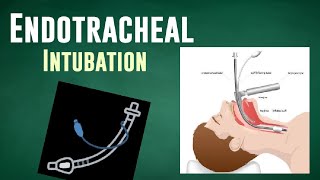 ENDOTRACHEAL INTUBATION  ET Tube Insertion [upl. by Gildus]