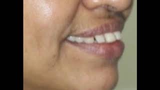 Dr Dharmesh H S Geetha Dental Clinic 9845338403 wwwalignersbracescom [upl. by Imtiaz]