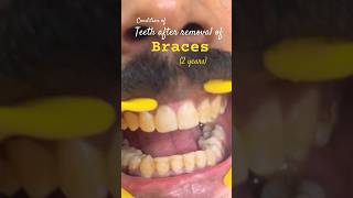 How teeth appear after removalof brackets✂️Part 1 orthodontics treatment trending youtubeshorts [upl. by Sterne383]