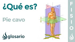 PIE CAVO  Qué es causas síntomas a quién afecta y tratamiento [upl. by Sheryl]