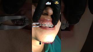 Braces GONE Smile ON braces removal straightteeth bestdentistdentalclinicrudrapurshort [upl. by Nea]