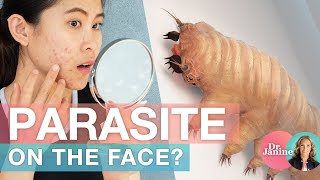 Parasites on the Face  Dr J9 Live [upl. by Doak]