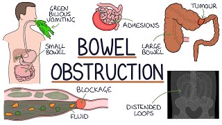 Understanding Bowel Obstruction [upl. by Virgin]