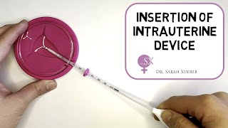 Insertion of Intrauterine Device [upl. by Anoyet110]