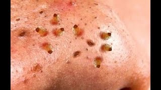 How To Removal Blackhead And How To Get Rid Of Blackhead Blackhead On Face 1 [upl. by Trebmer]