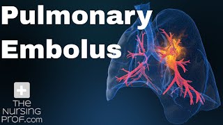 Pulmonary Embolus Nursing Care [upl. by Keviv850]