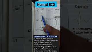 normal ECG and complex ECG dont forget to subscribe neetpyq drmoumitadebnat [upl. by Derk]