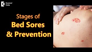 BED SORES DECUBITUS ULCERS Stages Causes Symptoms amp TreatmentDrAruna Prasad  Doctors Circle [upl. by Gunas]