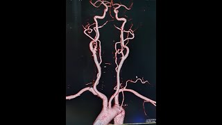 CT Carotid amp Cereberal Angio [upl. by Noyes9]