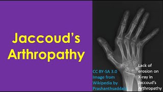 Jaccoud’s Arthropathy [upl. by Graf]