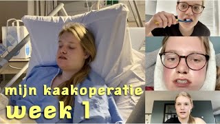 MIJN DUBBELE KAAKOPERATIE  1 WEEK HERSTEL  KAAKOPERATIE 2  ILSE DE ROO [upl. by Denis753]