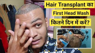 Hair Transplant 1st Head Wash Kitne Din Me Karna Chahiye  Hair Transplant Result In India Raipur Cg [upl. by Onilegna69]