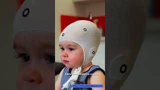 Infant Deformed Head Shaping Helmet Plagiocephaly Therapy UK [upl. by Irtemed]