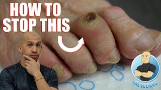 FOOT CORN REMOVAL FULL TREATMENT  FOOT HEALTH MONTH 2018 3 [upl. by Stanfield276]