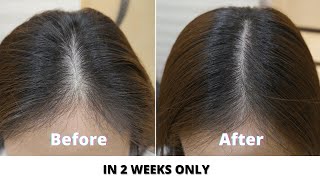 Simple home remedies to prevent hair loss and regrow hair naturally in 2 weeks I Stop hair fall 2021 [upl. by Zetana]