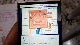 CHRONIC SUPPURATIVE OTITIS MEDIA part 1 general explanation with types must watch to get it [upl. by Notac]