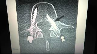 Spinal Implants Pedicle screws [upl. by Read]