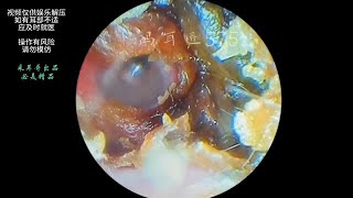 采耳哥External auditory canal cholesteatoma and fungal steatoma ｜585 [upl. by Huan920]