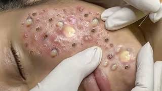 Big Cystic Acne Blackheads Extraction Blackheads amp Milia Whiteheads Removal Pimple Popping 011 [upl. by Latsyc]