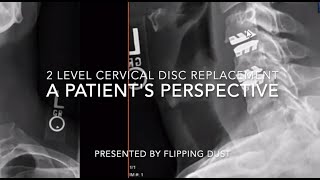 Two Level Cervical Disc Replacement A Patients Perspective HD 1080p [upl. by Limaa]