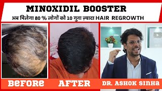 Minoxiboost Minoxidil Booster For Hair Growth  New Hair Research  10x More Result  Hair Loss [upl. by Ariayek980]