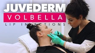 Juvederm Volbella Lip Injections  Juvederm Volbella Los Angeles CA [upl. by Adelbert]