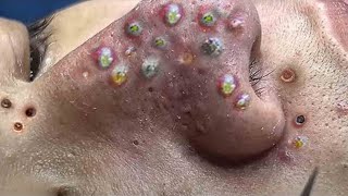 Big Cystic Acne Blackheads Extraction Blackheads amp Milia Whiteheads Removal Pimple Popping  3664 [upl. by Paco]