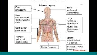 Principles of pain management and warning signs of sickle cell disease webinar [upl. by Kissel]