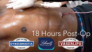 GYNECOMASTIA SURGERY 18 Hrs PostOp ‼️VASER 4D HIDEF LIPO Gland Removal amp JPLASMA  Dr Lebowitz [upl. by Uhayile]