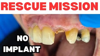 Tooth Implant is EXPENSIVE 😱😱  Front Tooth Restoration using Fiber Post in 10 minutes [upl. by Norym82]