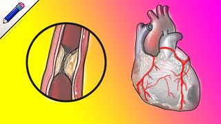 ENFERMEDAD CORONARIA [upl. by Ardnoel86]